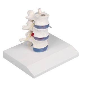 Lumbale wervels + hernia (verzakte schijf)