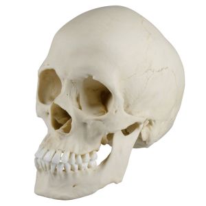 Scaphocefale schedel (craniosynostose)