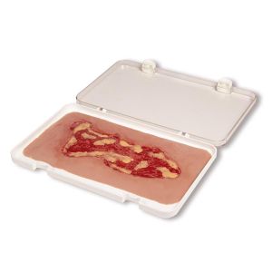 Wondmoulage veneuze beenulcus, groot, exsudatiefase