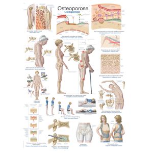 Osteoporoseposter, 70 x 100 cm