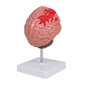 Hersenpathologieën