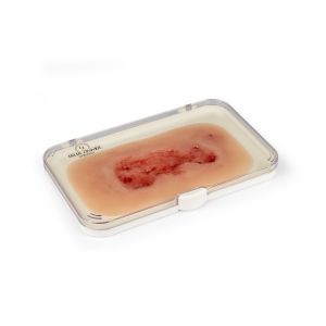 Wondmoulage veneuze beenulcus, klein, epithelisatiefase