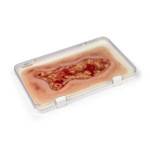Wondmoulage veneuze beenulcus, groot, exsudatiefase