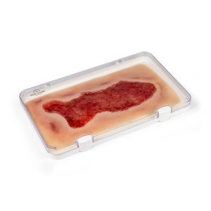 Wondmoulage veneuze beenulcus, groot, granulatiefase