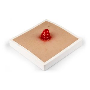Wondmoulage Ileostoma, incl. stellage