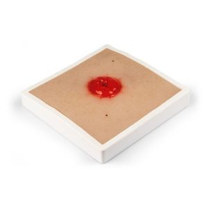 Wondmoulage Colostoma, incl. stellage
