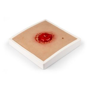 Wondmoulage Colostoma met ontsteking, incl. stellage