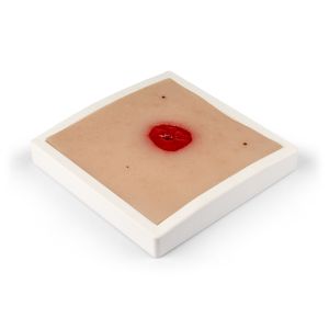 Wondmoulage Colostoma onder huidniveau, incl. stellage