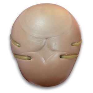 Craniale venapunctie voor R 17700