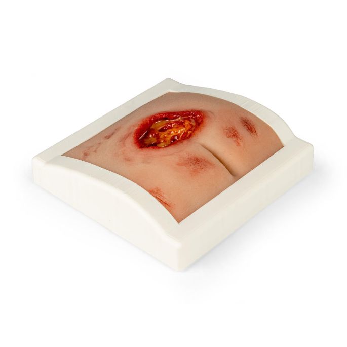 Wondmoulage sacrale decubitus