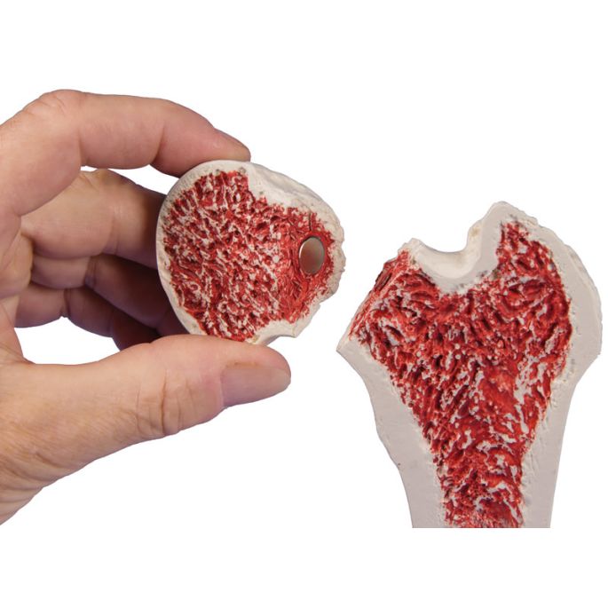 Femur met osteoporose