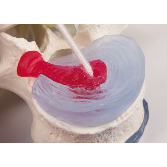 Lumbale wervels + hernia (verzakte schijf) - afbeelding 2