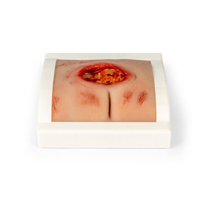 Wondmoulage sacrale decubitus