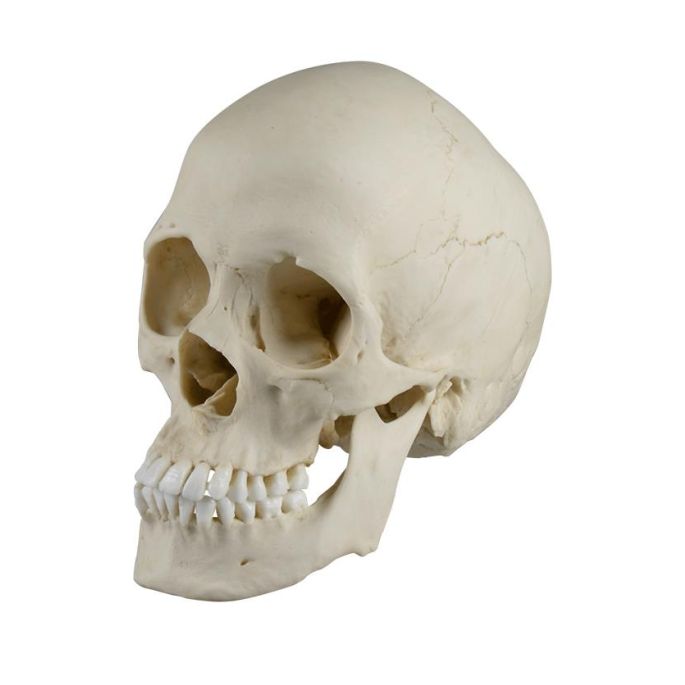 Scaphocephalische schedel