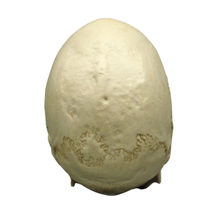 Scaphocephalische schedel