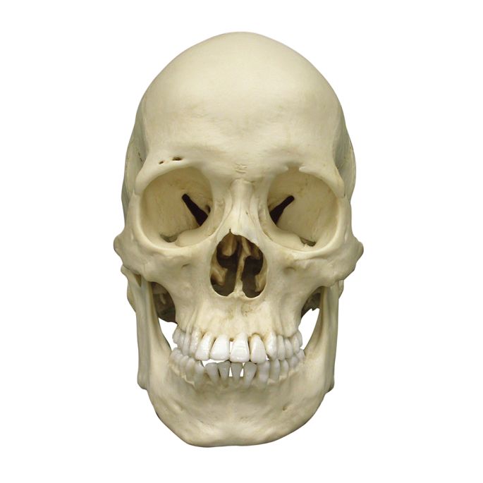 Scaphocefale schedel (craniosynostose) - afbeelding 5