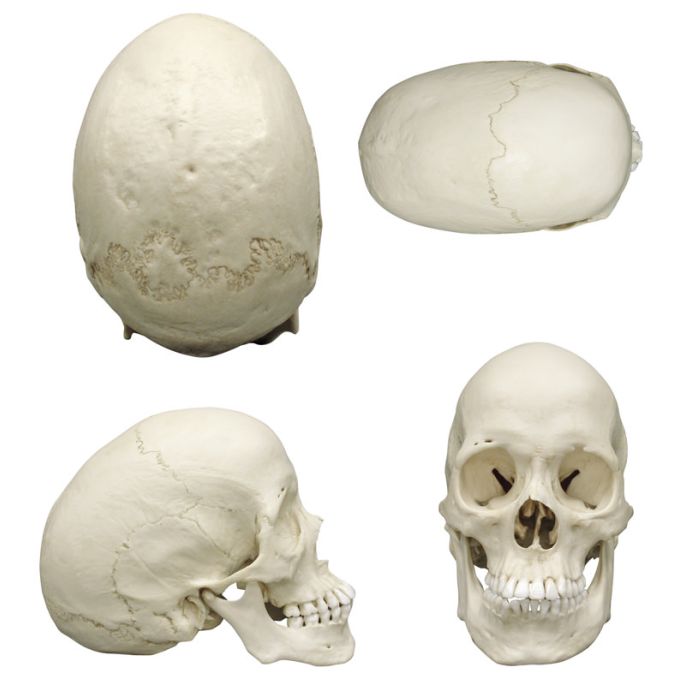 Scaphocefale schedel (craniosynostose) - afbeelding 6