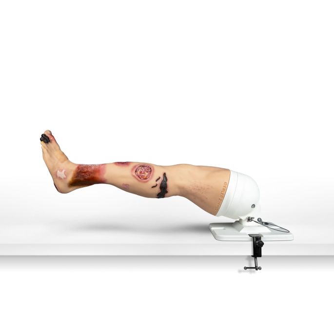 Lena Leg, been met ziektebeelden