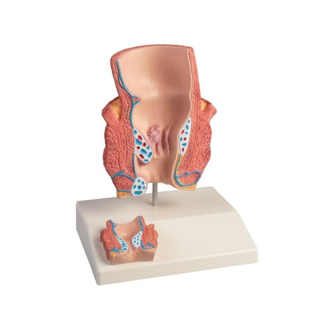 Aambeien model