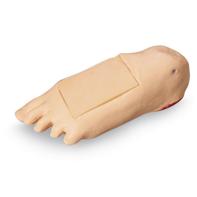 Oedeemvoet met diep weefselletsel voor GERI/KERI