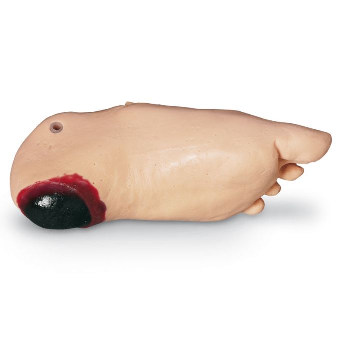 Oedeemvoet met diep weefselletsel voor GERI/KERI