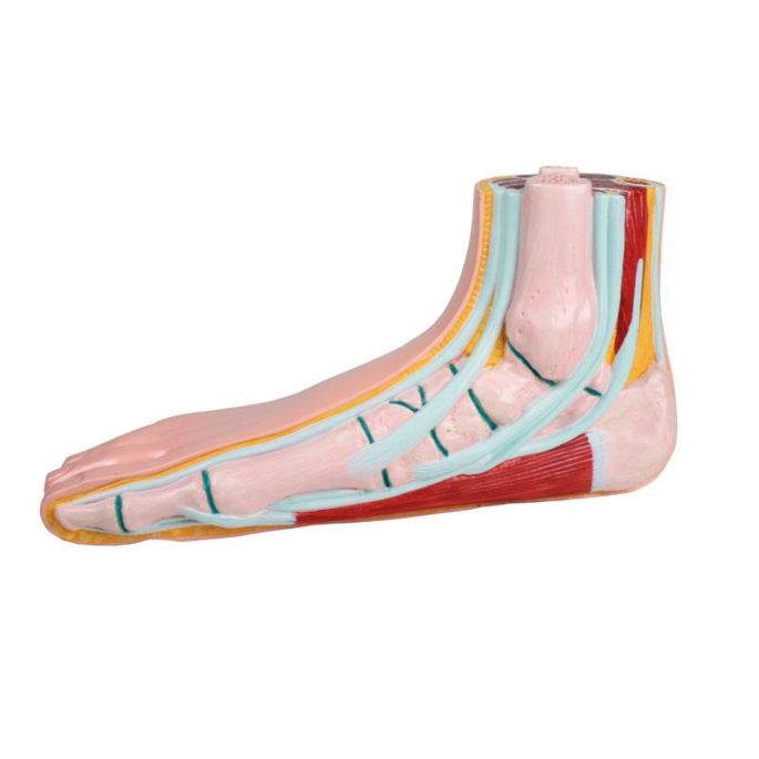 Platvoet, pes planus