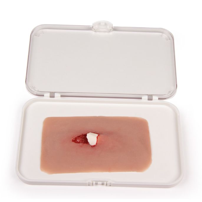 Wondmoulage 'open fractuur'