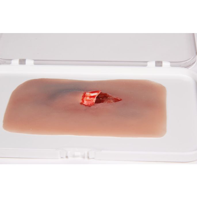 Wondmoulage 'open fractuur'