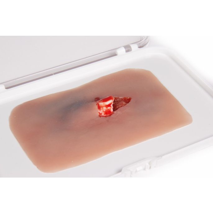 Wondmoulage 'open fractuur'