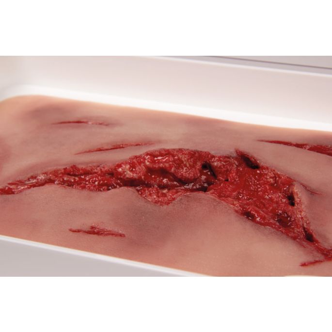 Wondmoulage laceratie, groot met bloedingsfunctie