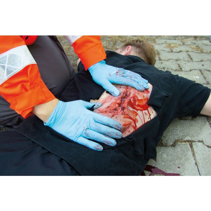 Wondmoulage laceratie, groot met bloedingsfunctie