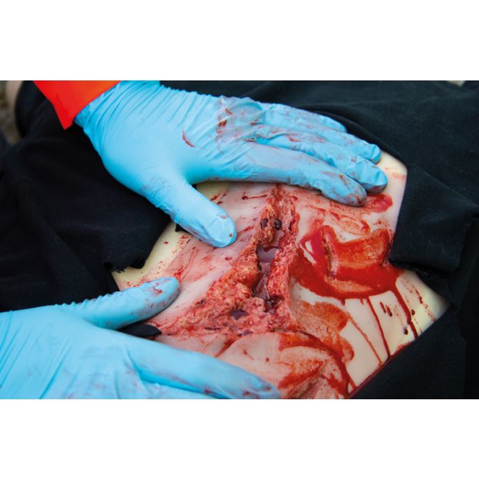 Wondmoulage laceratie, groot met bloedingsfunctie