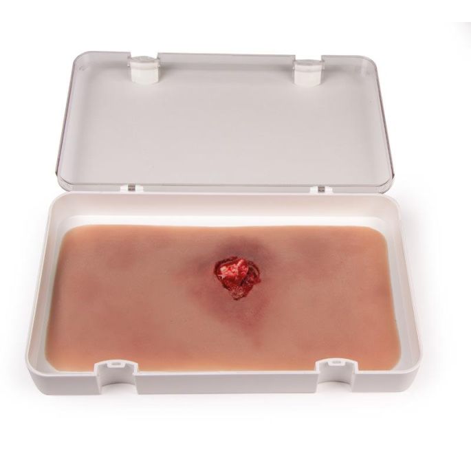 Wondmoulage open fractuur, armbot met bloedingsfunctie