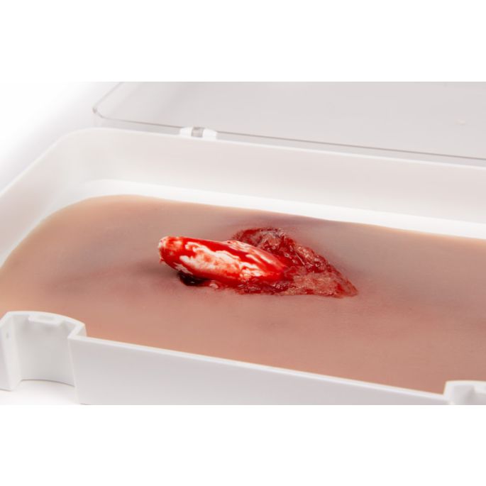 Wondmoulage open fractuur, been met bloedingsfunctie