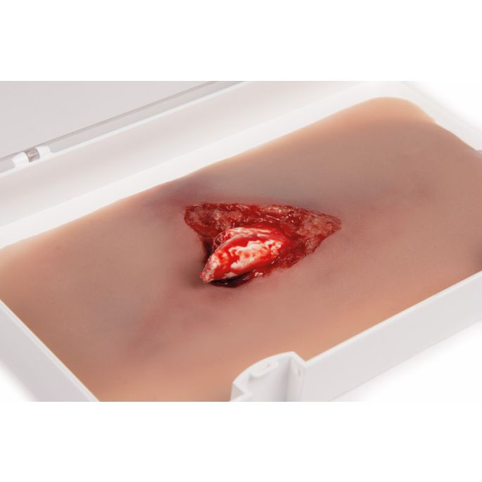 Wondmoulage open fractuur, been met bloedingsfunctie