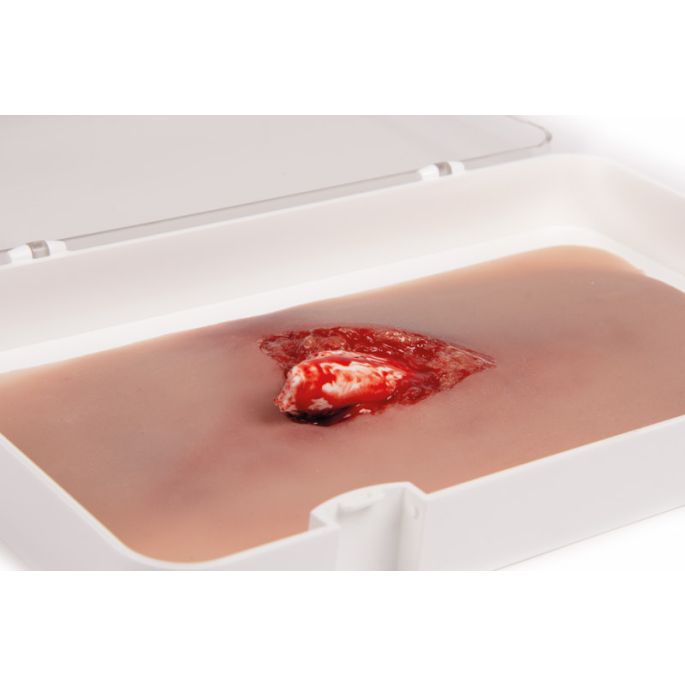 Wondmoulage open fractuur, been met bloedingsfunctie