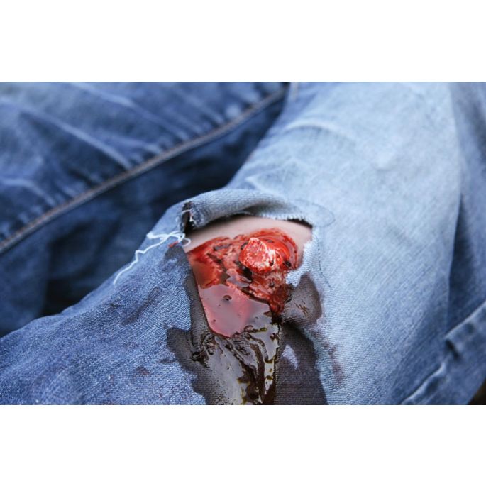 Wondmoulage open fractuur, been met bloedingsfunctie