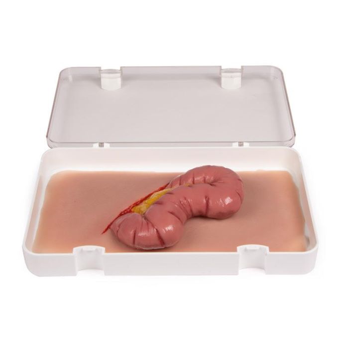 Wondmoulage uitsteeksel van de dikke darm