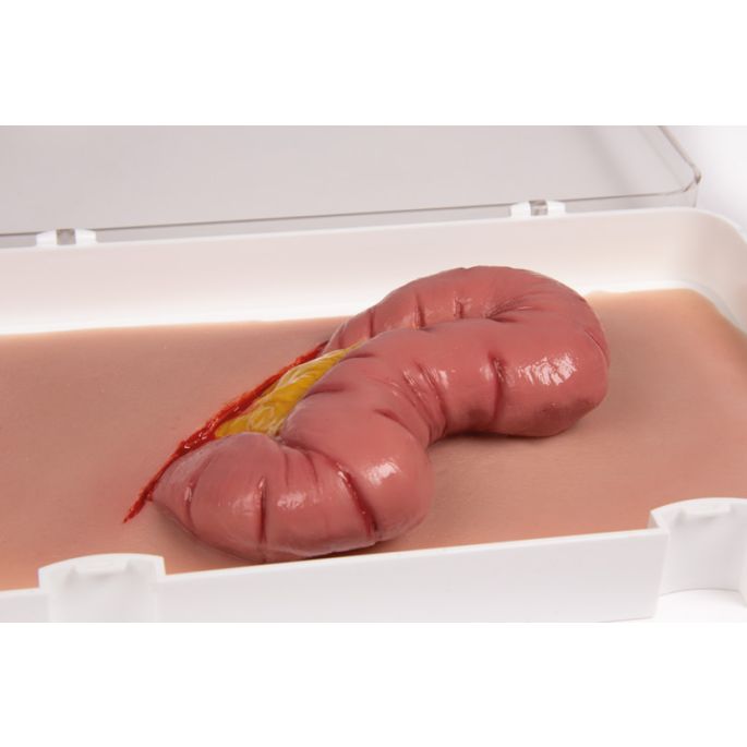 Wondmoulage uitsteeksel van de dikke darm