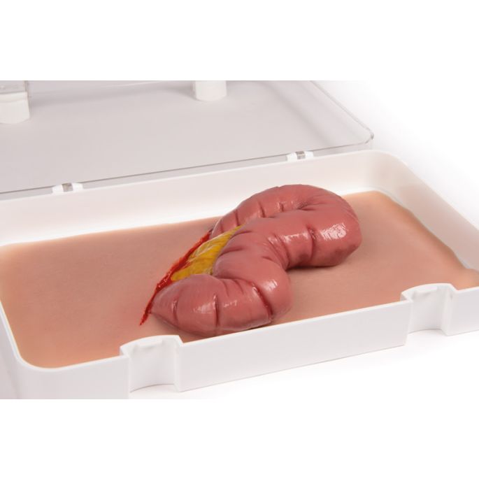 Wondmoulage uitsteeksel van de dikke darm