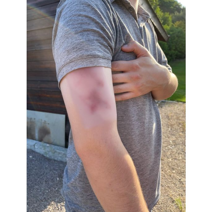 Wondmoulage hematoom vers