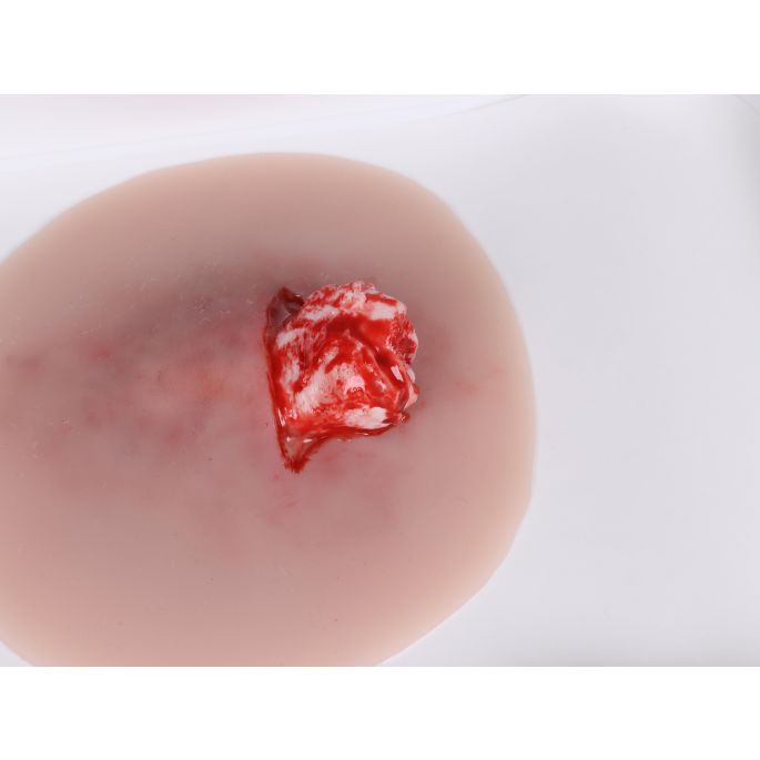 Wondpresentatie open fractuur enkelgewricht