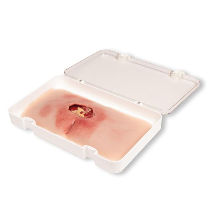 Wondmoulage sacrale decubitus, gereinigd