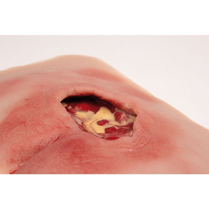 Wondmoulage sacrale decubitus, gereinigd