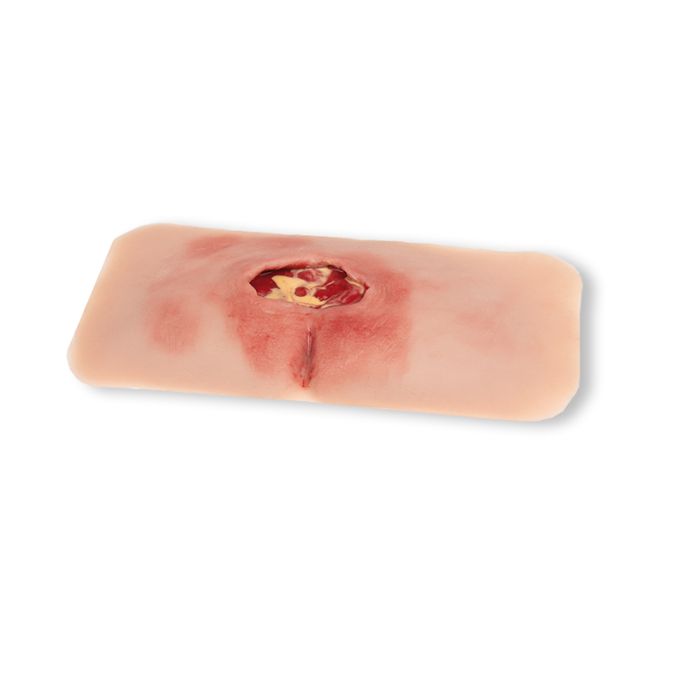 Wondmoulage sacrale decubitus, gereinigd