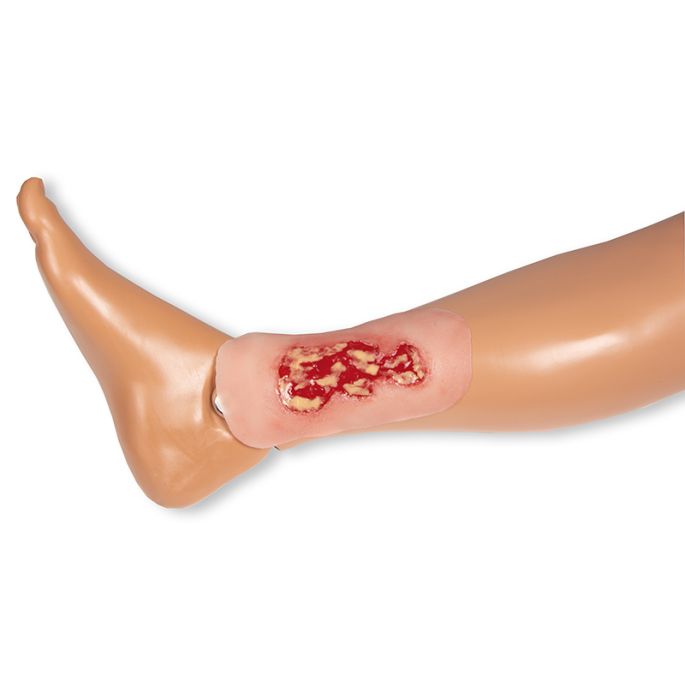 Wondmoulage veneuze beenulcus, klein, exsudatiefase