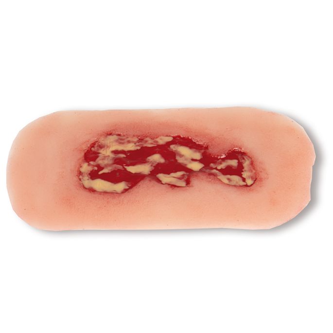 Wondmoulage veneuze beenulcus, klein, exsudatiefase