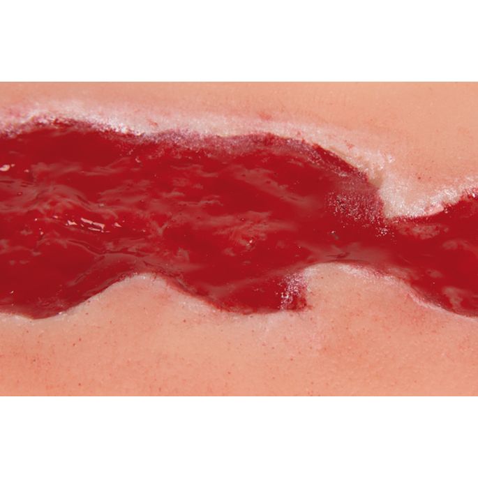 Wondmoulage veneuze beenulcus, klein, granulatiefase