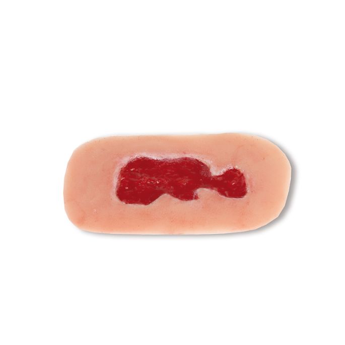 Wondmoulage veneuze beenulcus, klein, granulatiefase