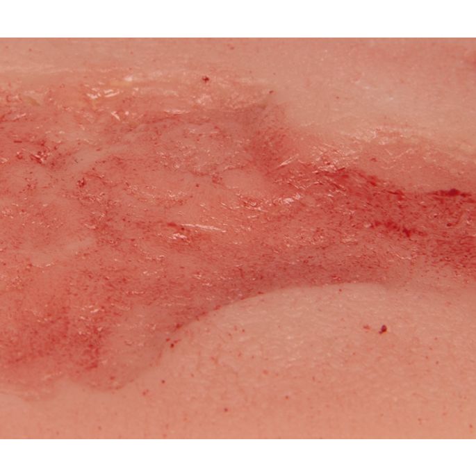 Wondmoulage veneuze beenulcus, klein, epithelisatiefase